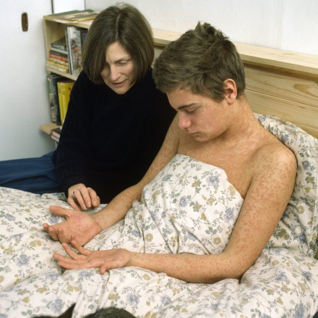 Spalničky jsou jednou z nejnakažlivějších lidských nemocí | foto: Fotobanka Profimedia